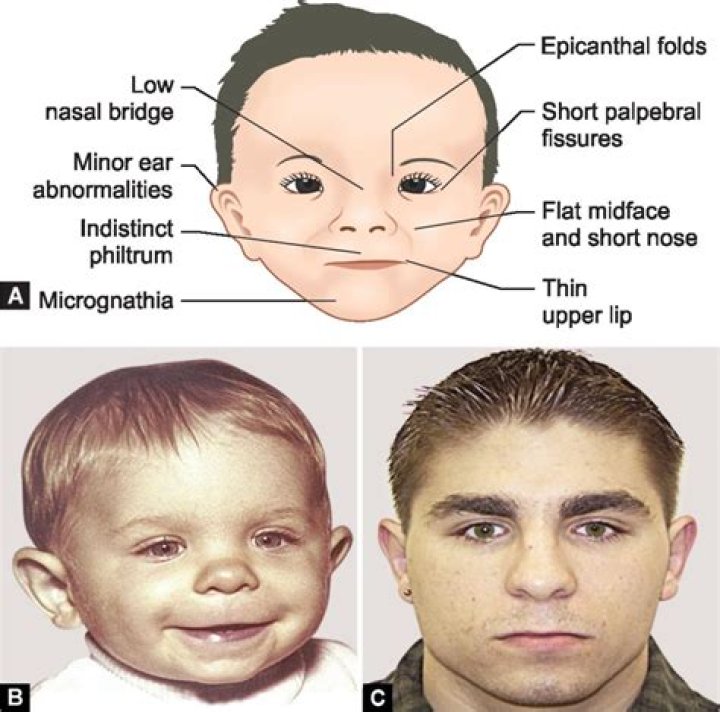 Does Brian Peppers Have Apert Syndrome? Convicted Sex Offender Whose Mugshot Went Viral In 2005