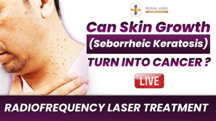 How to remove seborrheic keratosis