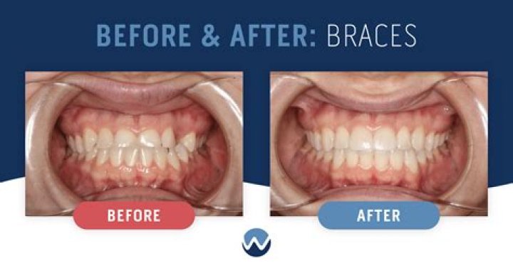 Ronda Rousey | Teeth Before And After